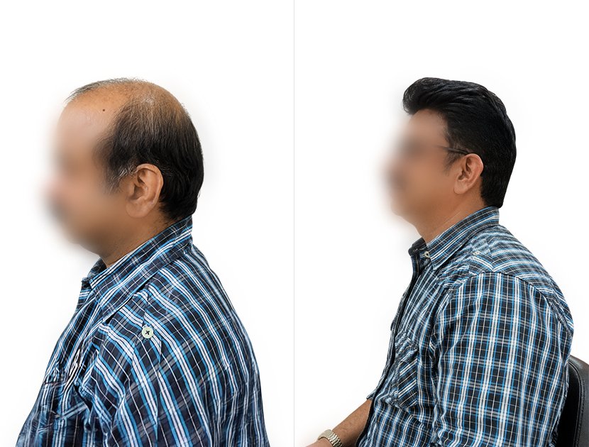 non-surgical hair replacement Bangalore